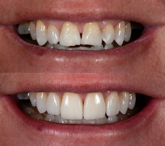 Partial Dentures For Back 
      Teeth Rockford MI 49341
